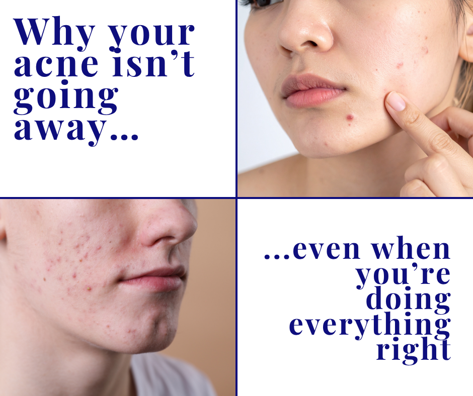 Why Your Acne Won’t Go Away (Even When You’re Doing Everything Right)