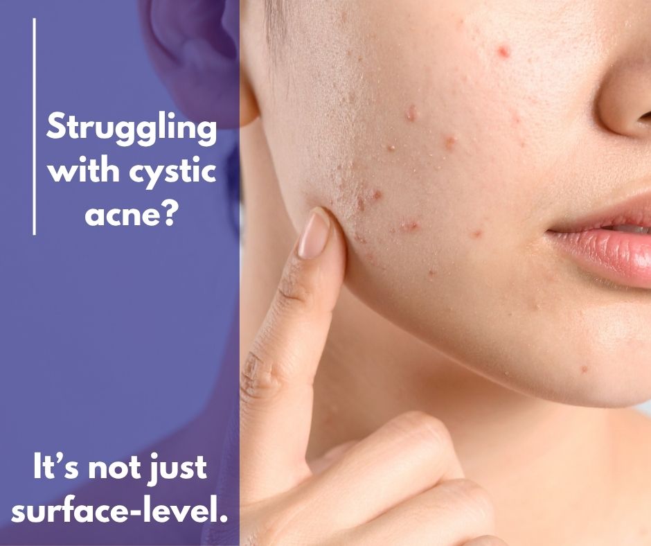 Understanding Cystic Acne: Causes, Treatments, and How to Support Your Skin
