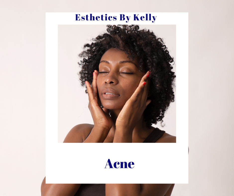 Woman touching her face gently, promoting skincare for acne treatment