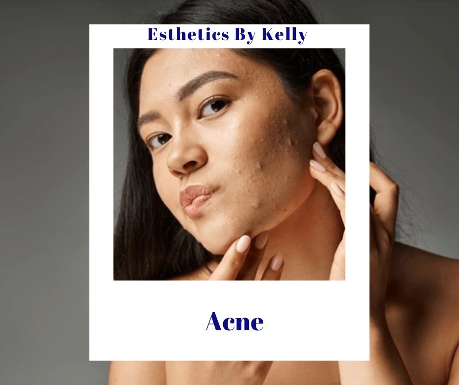 Woman touching her face gently, promoting skincare for acne treatment